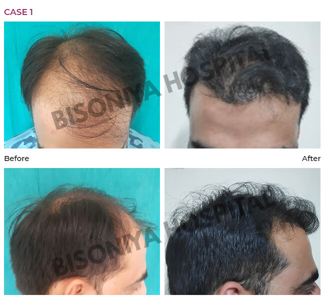Hair Transplant Bhopal - Case1