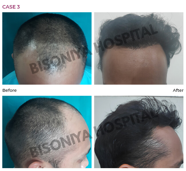 Hair Transplant Bhopal - Case3