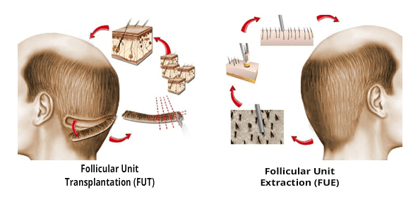 FUE and FUT - Technique