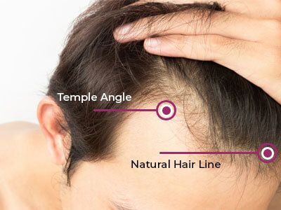 Why Us - Hair Transplant Bhopal